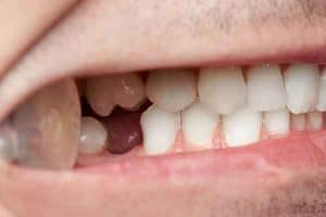 השתלת שן קדמית חשיבות השן